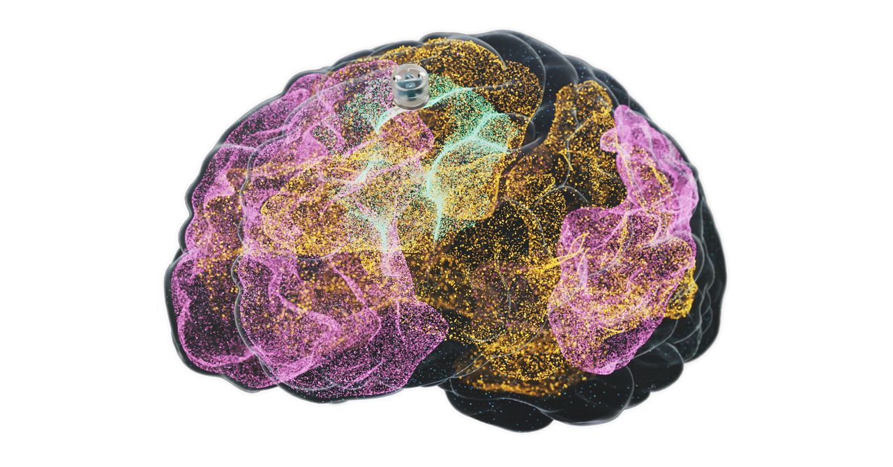 Implant não điều trị trầm cảm của Motif Neurotech được phép thử nghiệm trên người